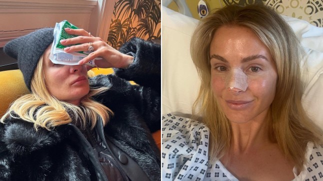Compilation image of Millie Mackintosh holding ice to her nose, and also in hospital bed with plaster on her nose.