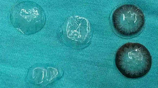 Doctors find five lost contact lenses behind woman's eye